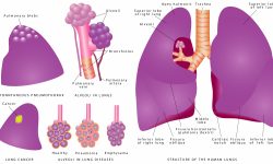 Are blebs deflating more than your lung? image